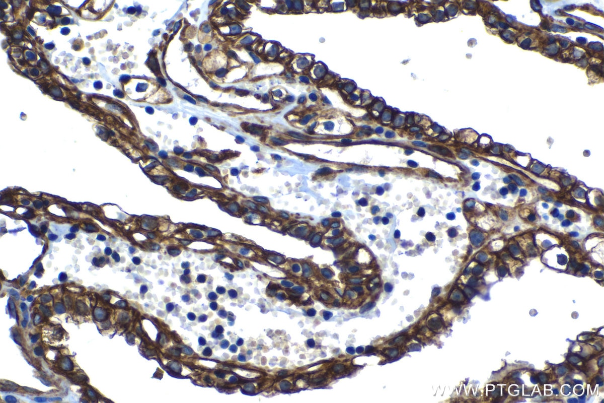 Immunohistochemical analysis of paraffin-embedded human renal cell carcinoma tissue slide using KHC1346 (STC2 IHC Kit).