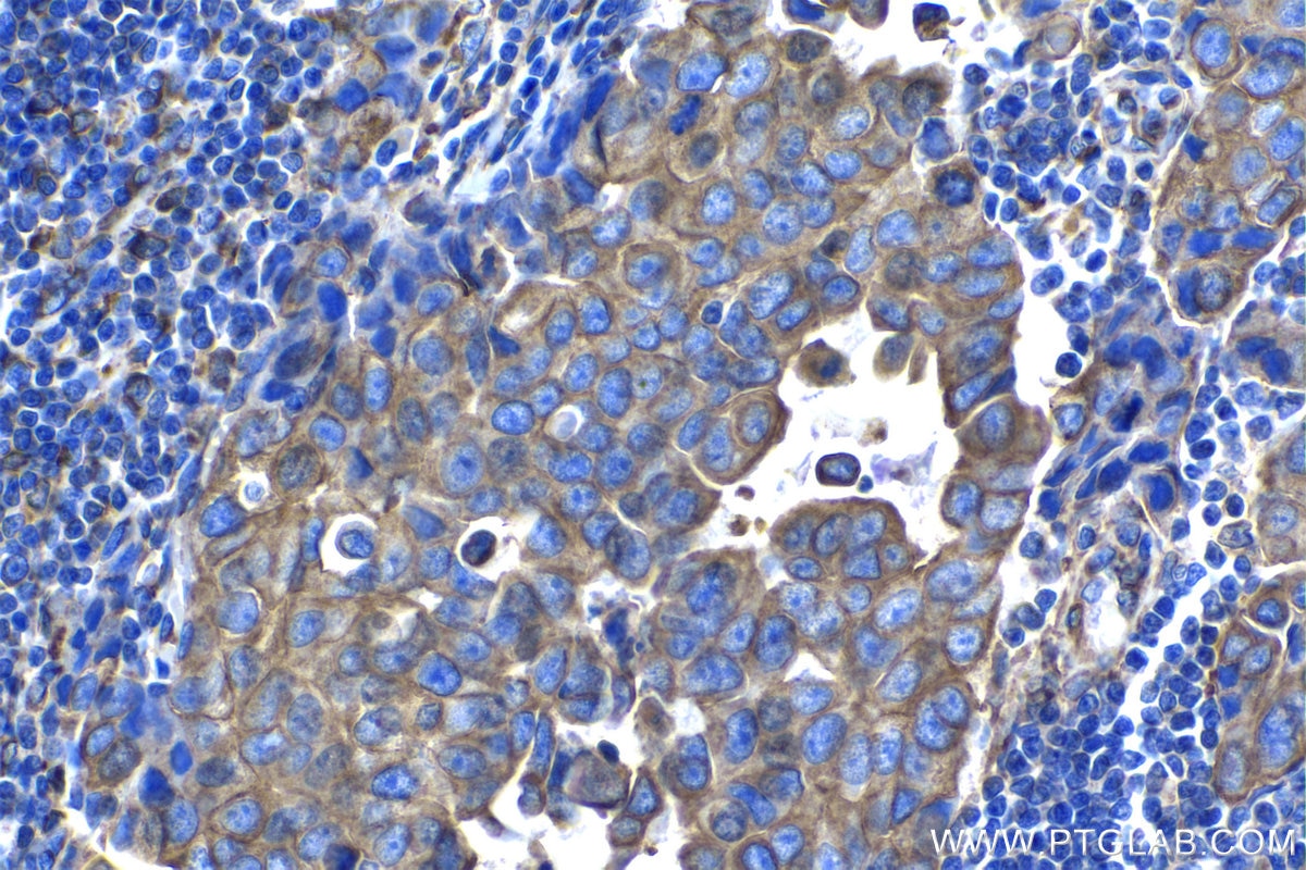 Immunohistochemical analysis of paraffin-embedded human breast cancer tissue slide using KHC1346 (STC2 IHC Kit).