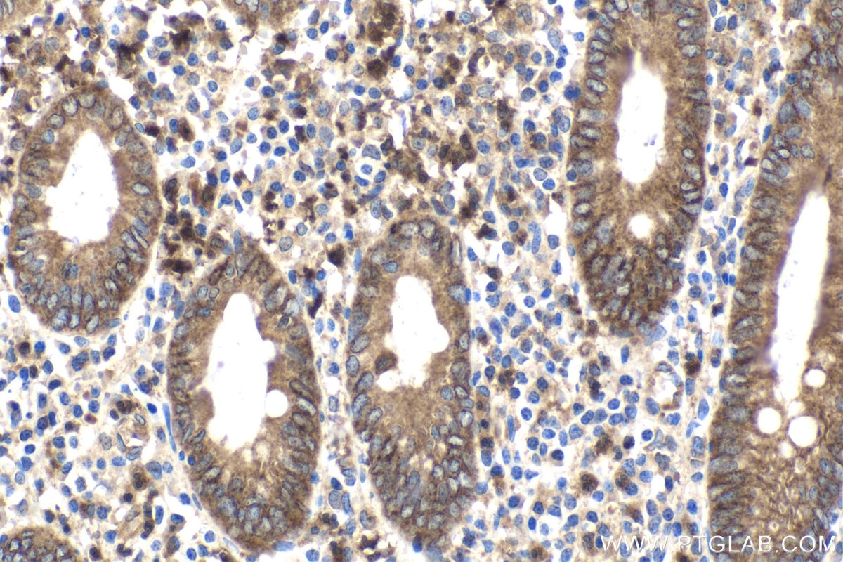 Immunohistochemical analysis of paraffin-embedded human appendicitis tissue slide using KHC1782 (STEAP3 IHC Kit).