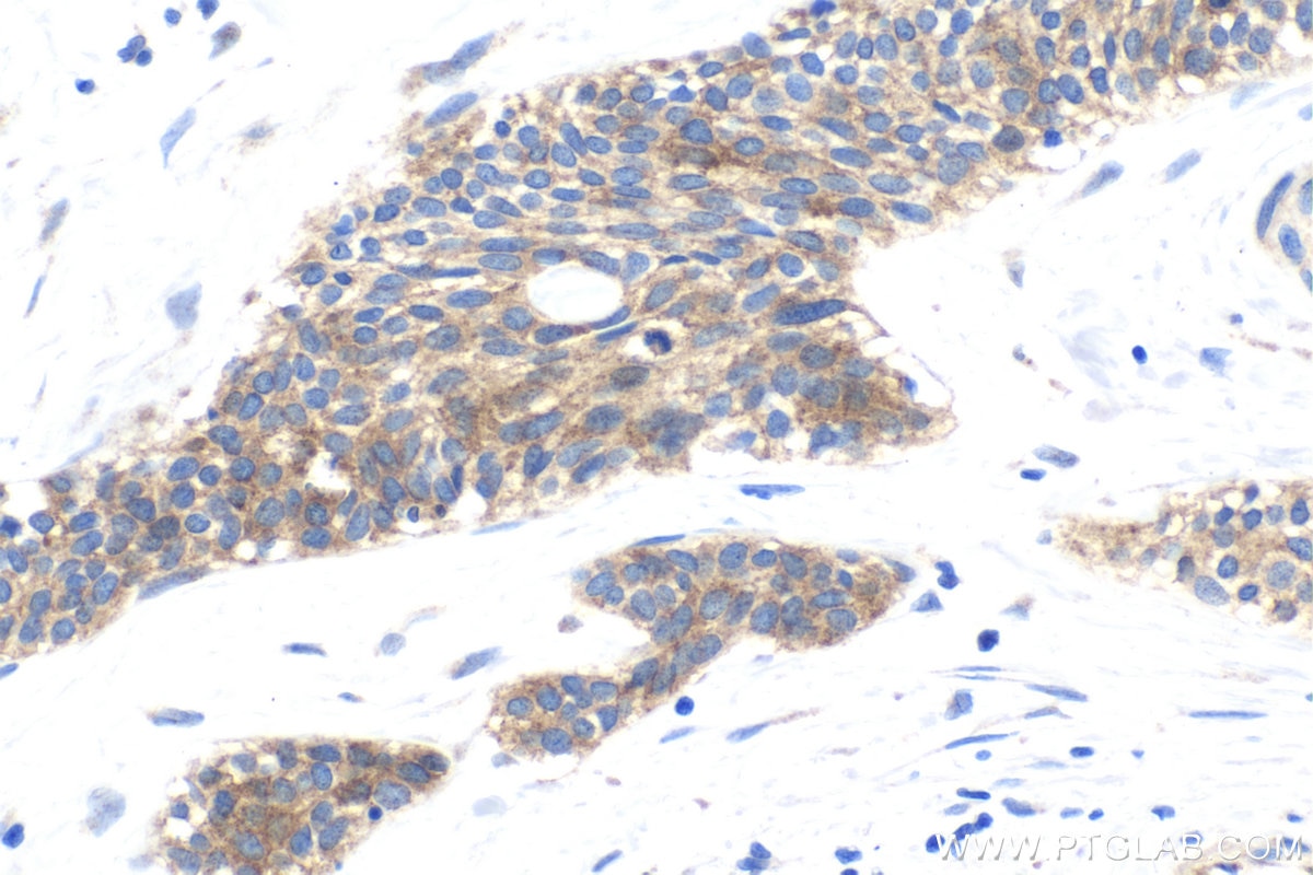 Immunohistochemical analysis of paraffin-embedded human urothelial carcinoma tissue slide using KHC1782 (STEAP3 IHC Kit).