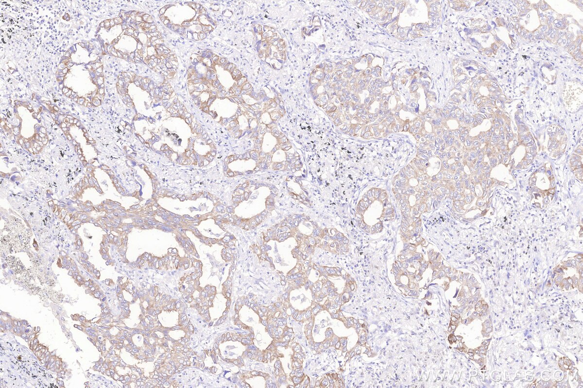 Immunohistochemical analysis of paraffin-embedded human lung cancer tissue slide using KHC3267 (STEAP4 IHC Kit).