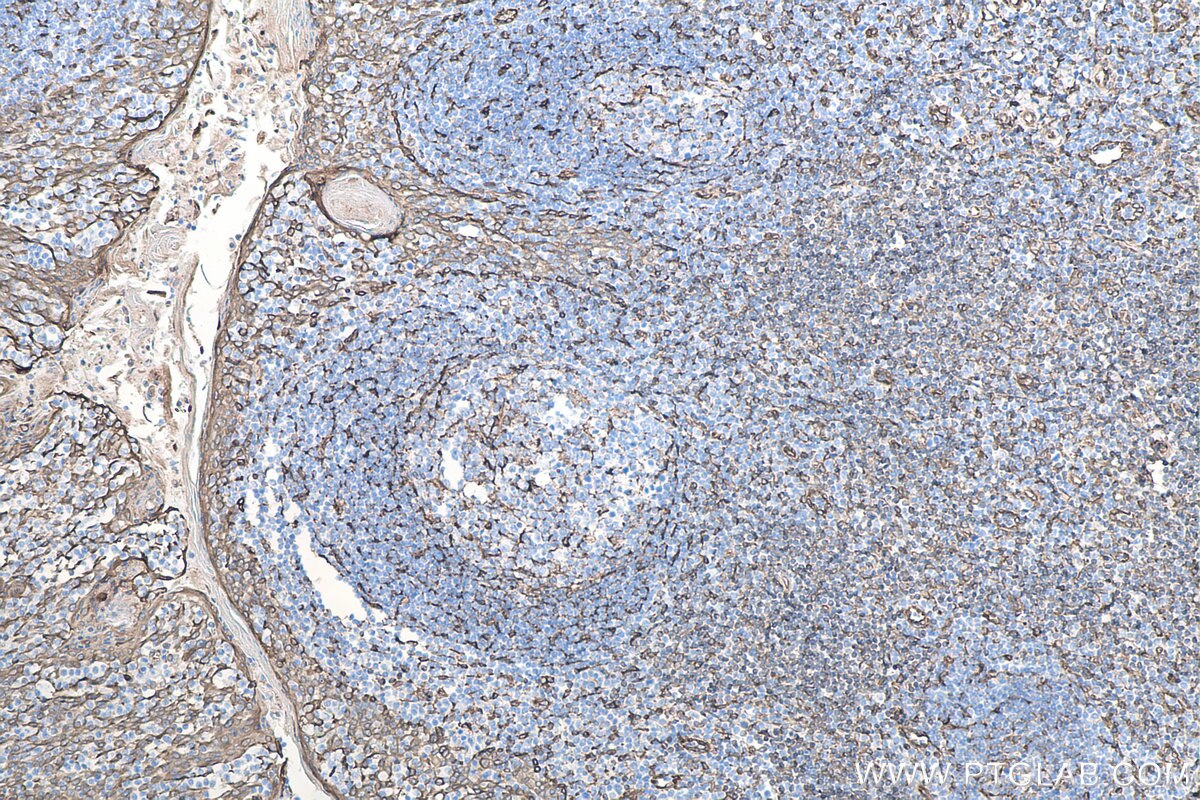 Immunohistochemical analysis of paraffin-embedded human tonsillitis tissue slide using KHC0060 (STING IHC Kit).