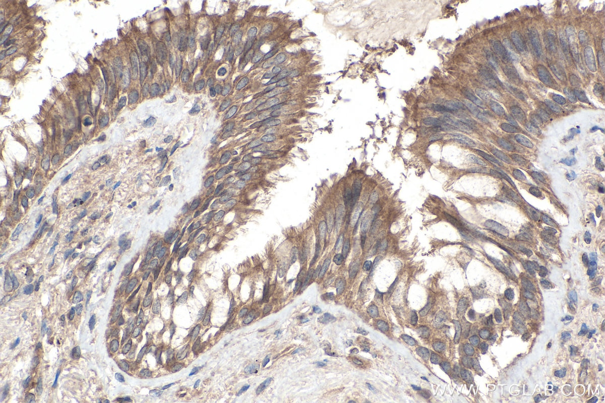 Immunohistochemical analysis of paraffin-embedded human lung cancer tissue slide using KHC0278 (STK11 IHC Kit).