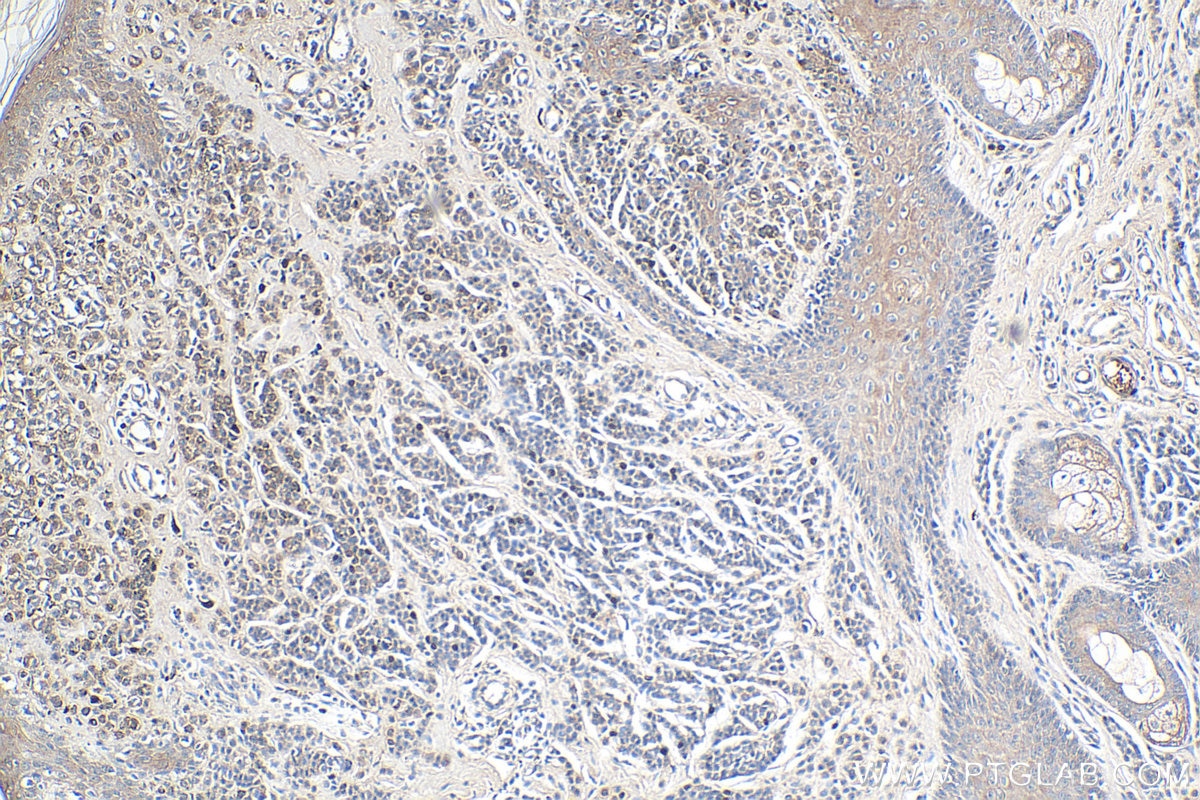 Immunohistochemical analysis of paraffin-embedded human malignant melanoma tissue slide using KHC0278 (STK11 IHC Kit).