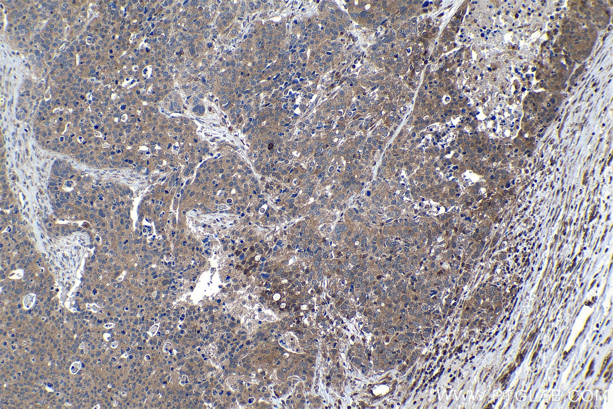 Immunohistochemical analysis of paraffin-embedded human ovary tumor tissue slide using KHC1152 (STK17B IHC Kit).