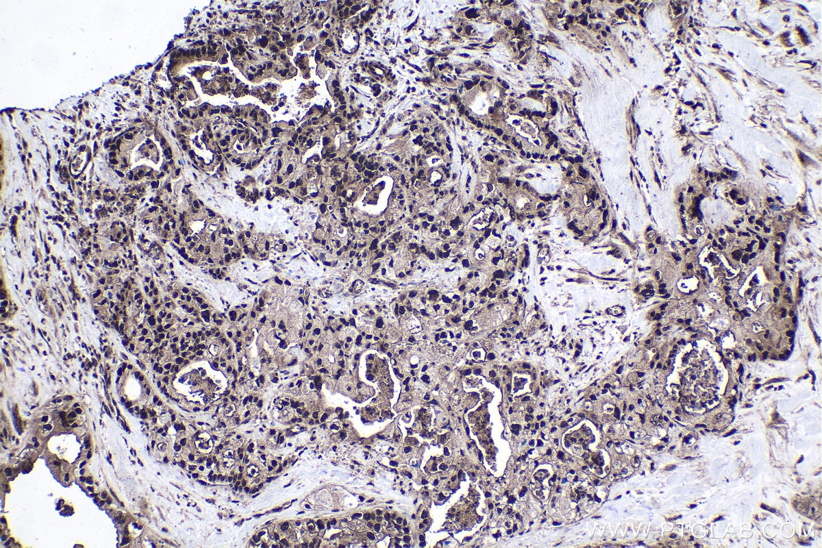 Immunohistochemical analysis of paraffin-embedded human pancreas cancer tissue slide using KHC1705 (STK3 IHC Kit).