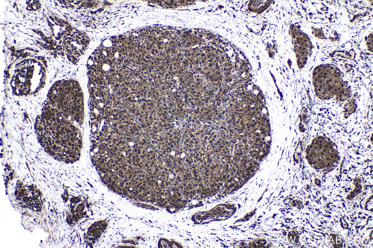 Immunohistochemical analysis of paraffin-embedded human thyroid cancer tissue slide using KHC1705 (STK3 IHC Kit).