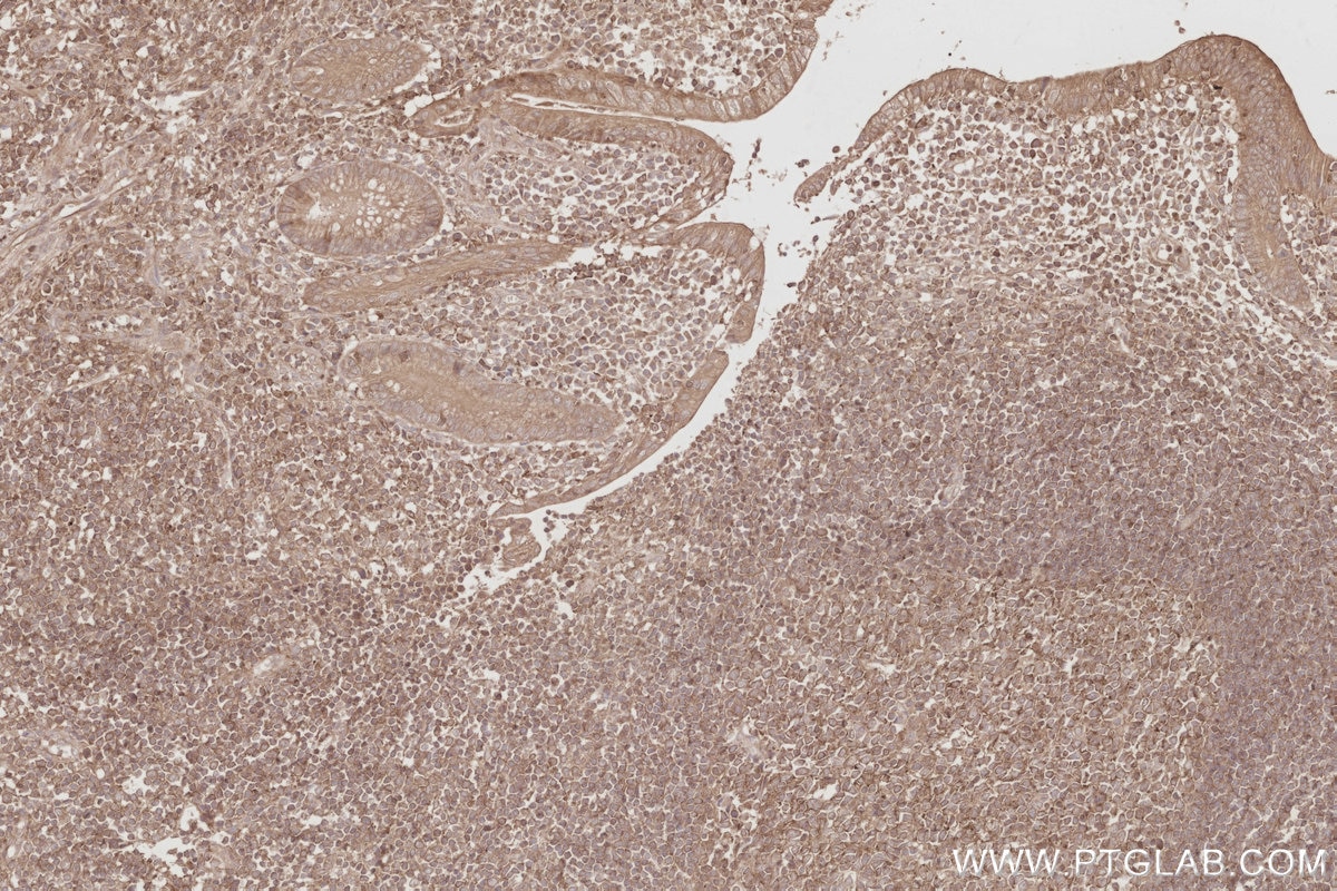 Immunohistochemical analysis of paraffin-embedded human appendicitis tissue slide using KHC2888 (STK33 IHC Kit). Immunohistochemical analysis of paraffin-embedded human appendicitis tissue slide using KHC2888 (STK33 IHC Kit).