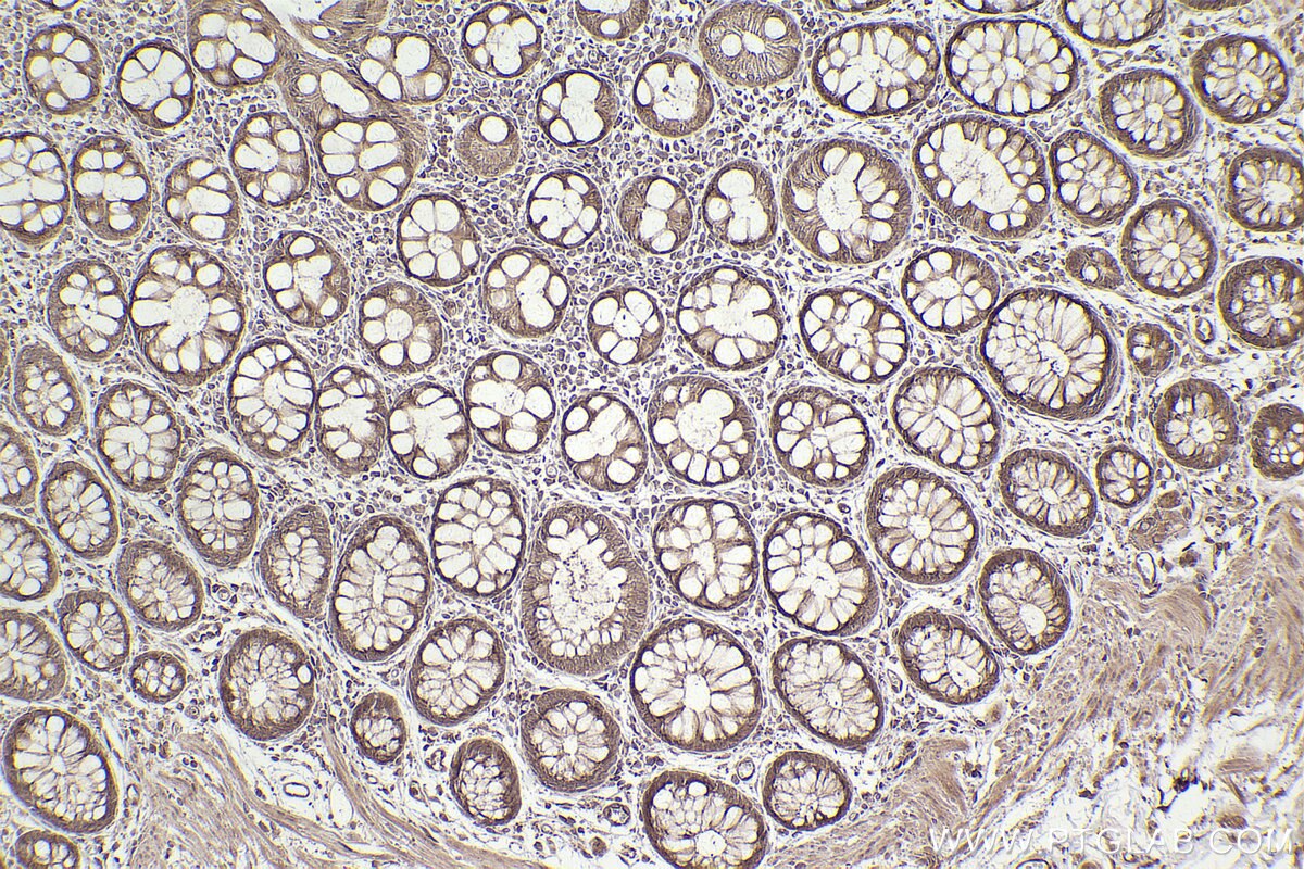 Immunohistochemical analysis of paraffin-embedded human rectal cancer tissue slide using KHC2483 (STK38 IHC Kit).