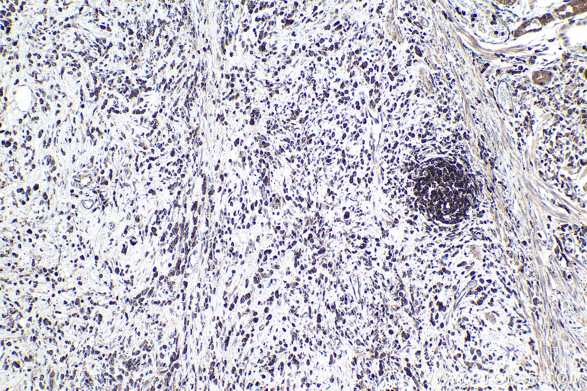 Immunohistochemical analysis of paraffin-embedded human stomach cancer tissue slide using KHC1699 (STK4 IHC Kit).