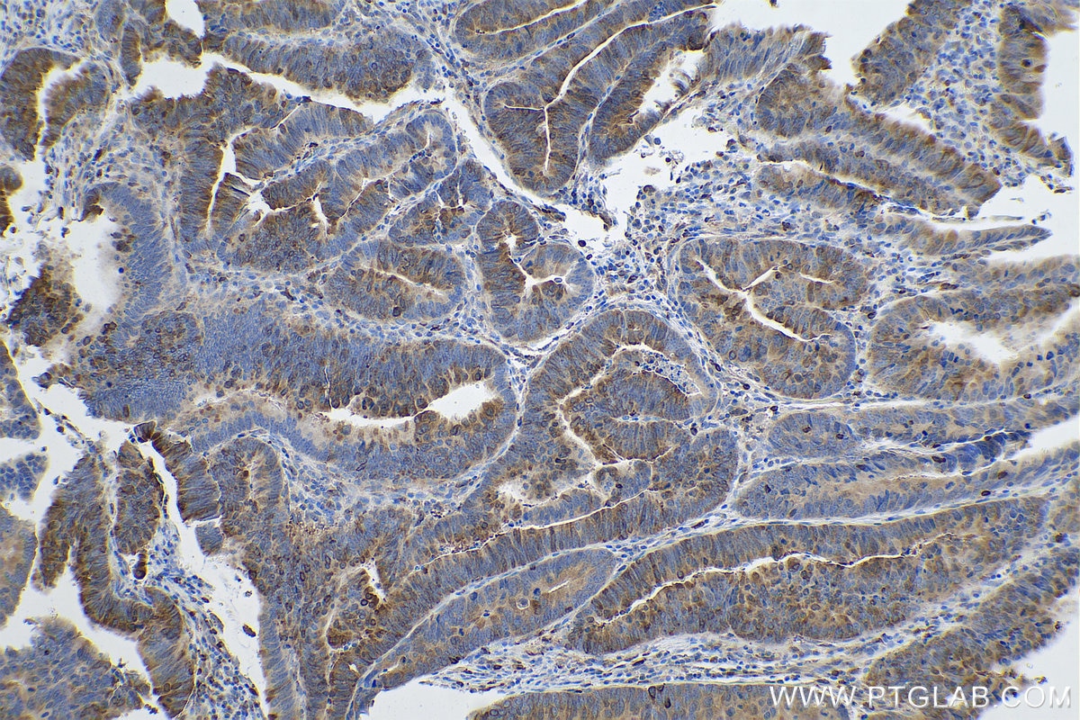 Immunohistochemical analysis of paraffin-embedded human colon cancer tissue slide using KHC0841 (Stathmin 1 IHC Kit).