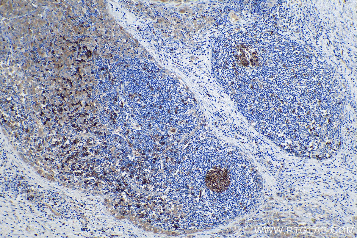 Immunohistochemical analysis of paraffin-embedded human lymphoma tissue slide using KHC0841 (Stathmin 1 IHC Kit).