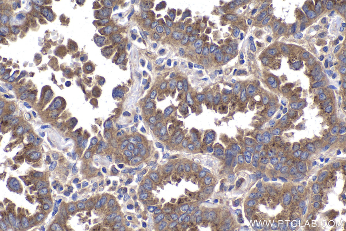 Immunohistochemical analysis of paraffin-embedded human lung cancer tissue slide using KHC2020 (STRAP IHC Kit).
