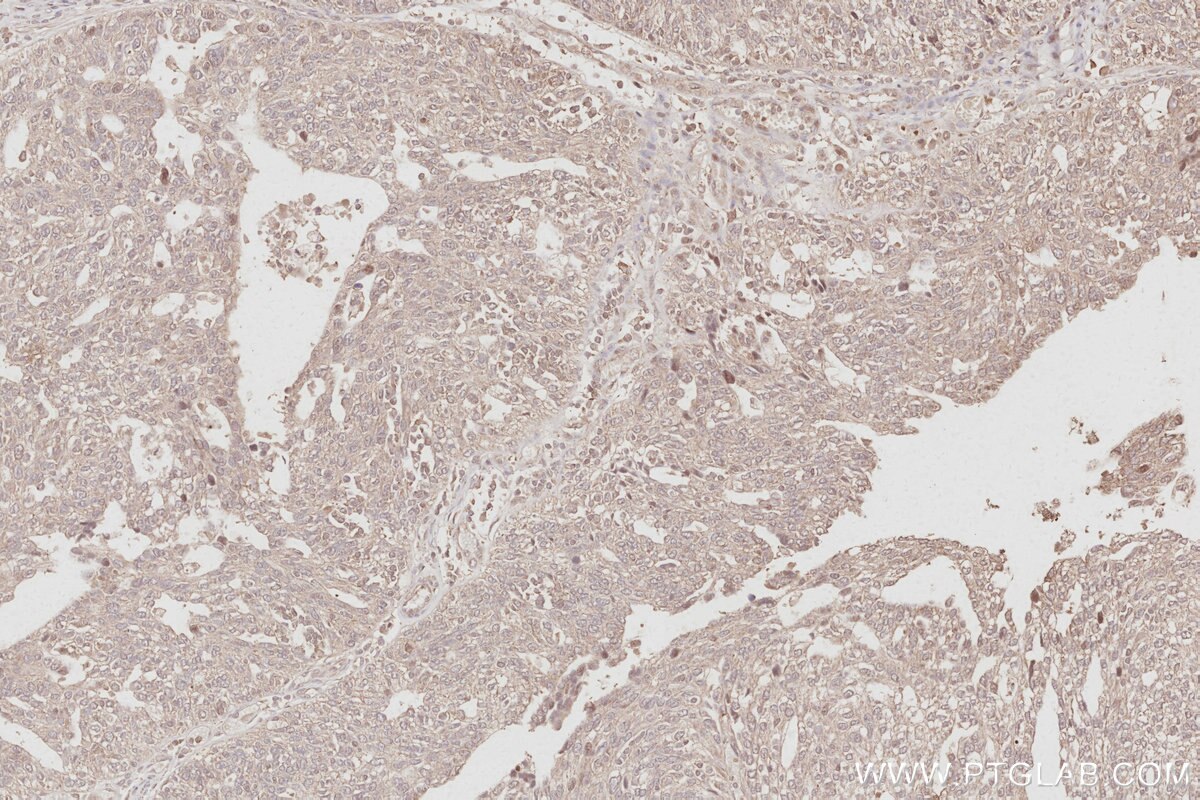 Immunohistochemical analysis of paraffin-embedded human ovary cancer tissue slide using KHC3092 (STYXL1 IHC Kit).