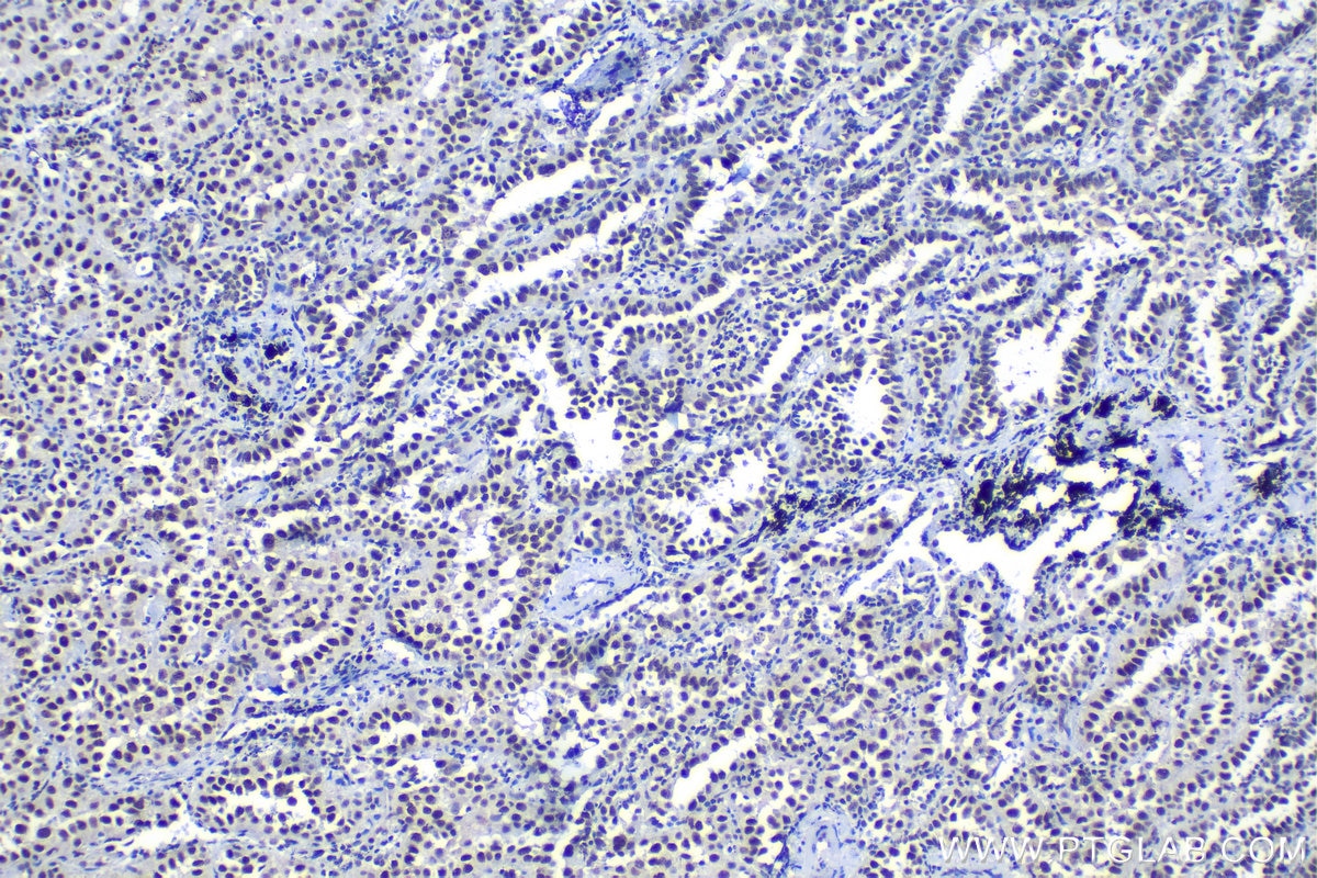 Immunohistochemical analysis of paraffin-embedded human lung cancer tissue slide using KHC1197 (SUB1 IHC Kit).