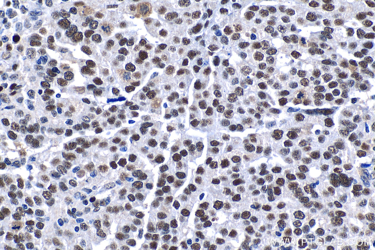 Immunohistochemical analysis of paraffin-embedded human ovary tumor tissue slide using KHC1197 (SUB1 IHC Kit).