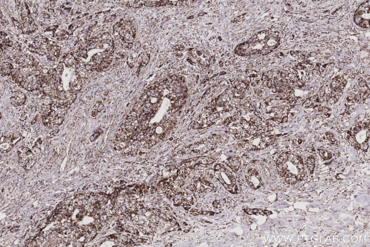 Immunohistochemical analysis of paraffin-embedded human pancreas cancer tissue slide using KHC2995 (SUCLA2 IHC Kit).
