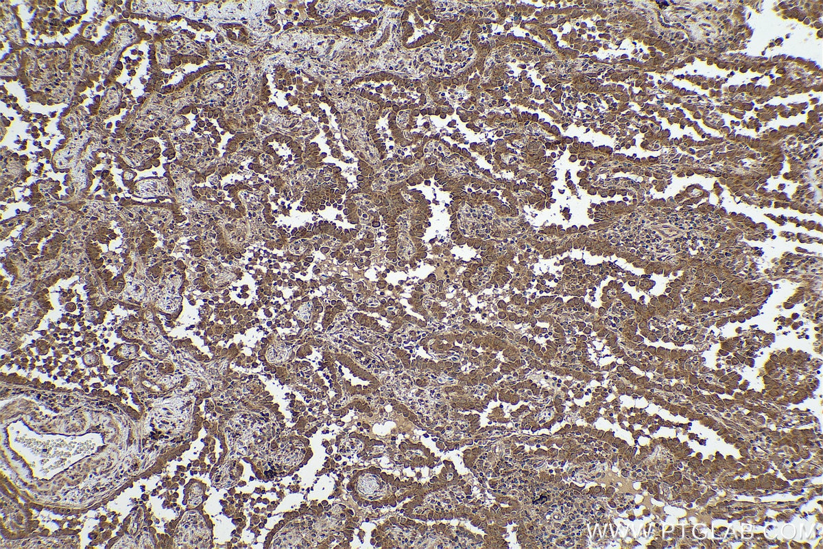 Immunohistochemical analysis of paraffin-embedded human lung cancer tissue slide using KHC0851 (SUGT1 IHC Kit).
