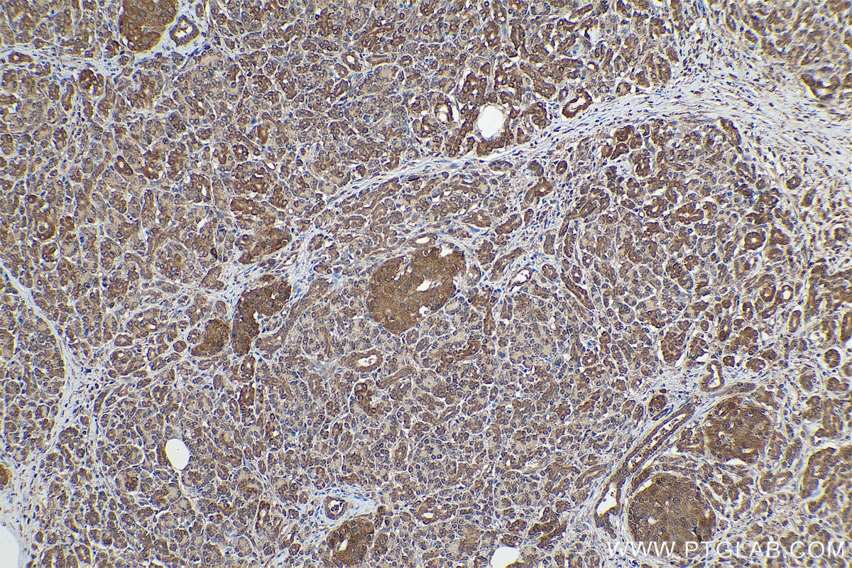 Immunohistochemical analysis of paraffin-embedded human pancreas cancer tissue slide using KHC0851 (SUGT1 IHC Kit).