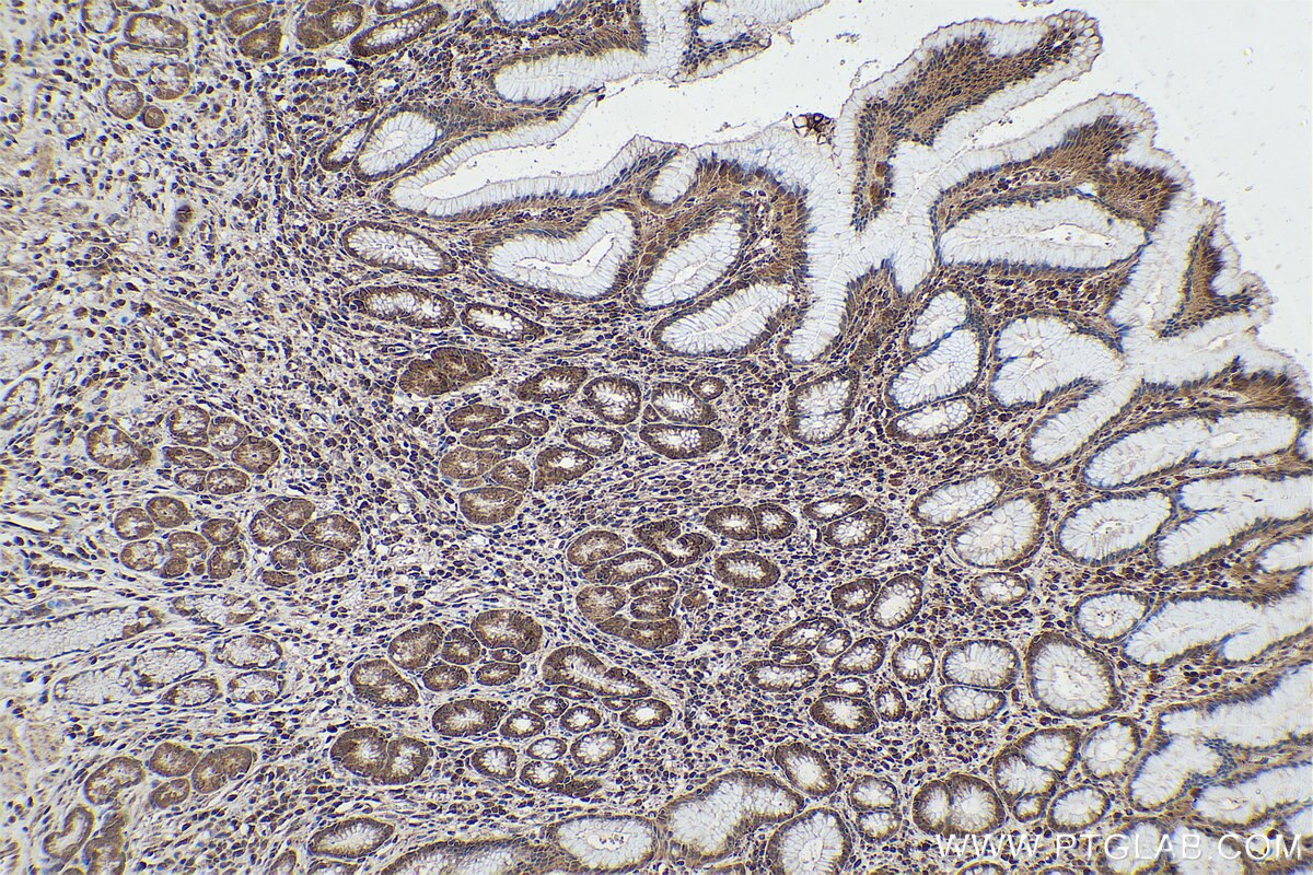 Immunohistochemical analysis of paraffin-embedded human stomach cancer tissue slide using KHC0851 (SUGT1 IHC Kit).