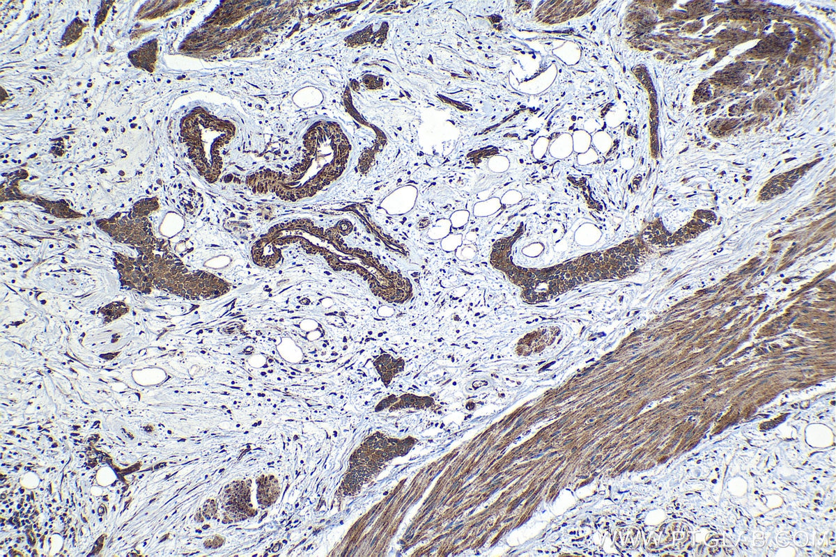 Immunohistochemical analysis of paraffin-embedded human urothelial carcinoma tissue slide using KHC1231 (SULF2 IHC Kit).