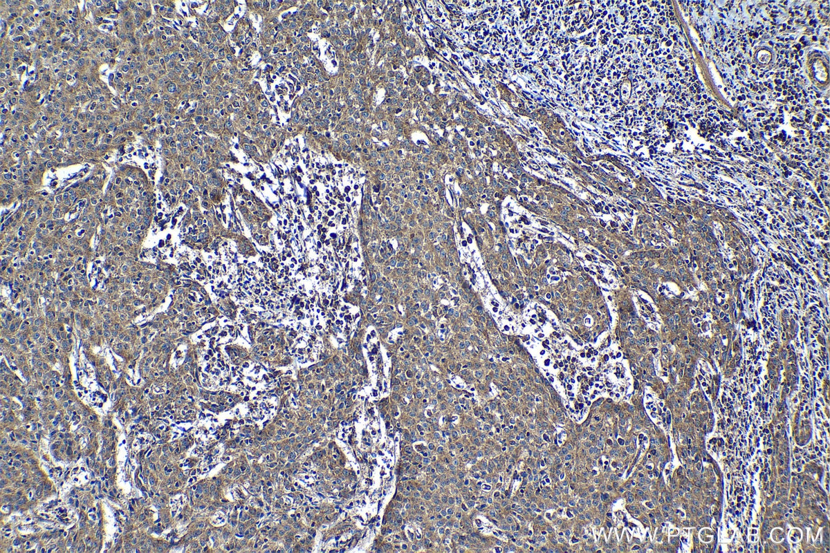 Immunohistochemical analysis of paraffin-embedded human cervical cancer tissue slide using KHC1231 (SULF2 IHC Kit).