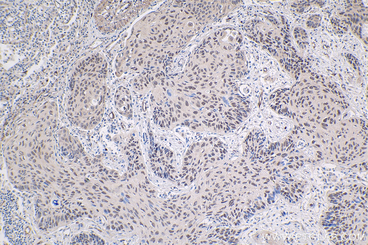 Immunohistochemical analysis of paraffin-embedded human lung cancer tissue slide using KHC1836 (SUPT20H/FAM48A IHC Kit).