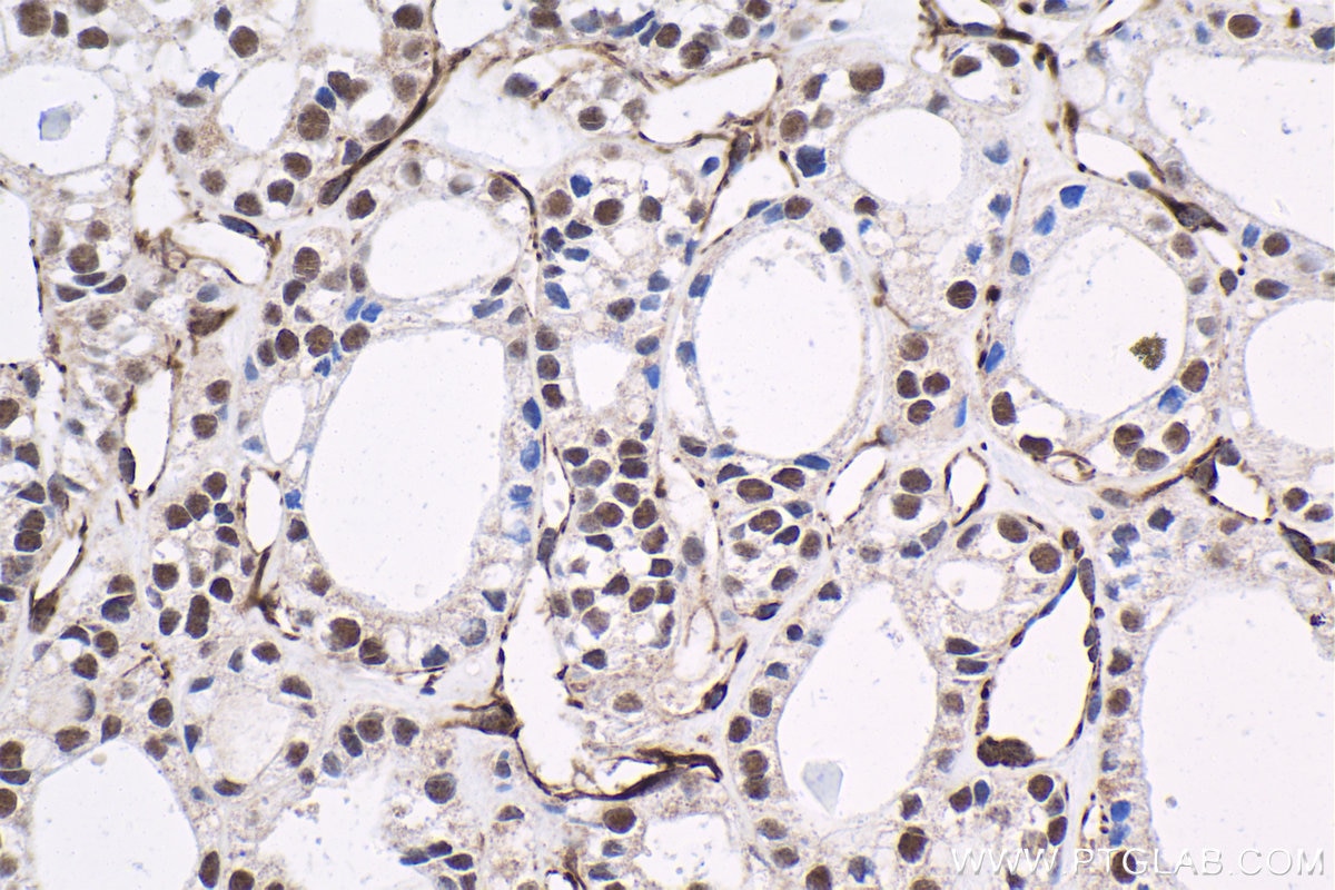 Immunohistochemical analysis of paraffin-embedded human thyroid cancer tissue slide using KHC1836 (SUPT20H/FAM48A IHC Kit).
