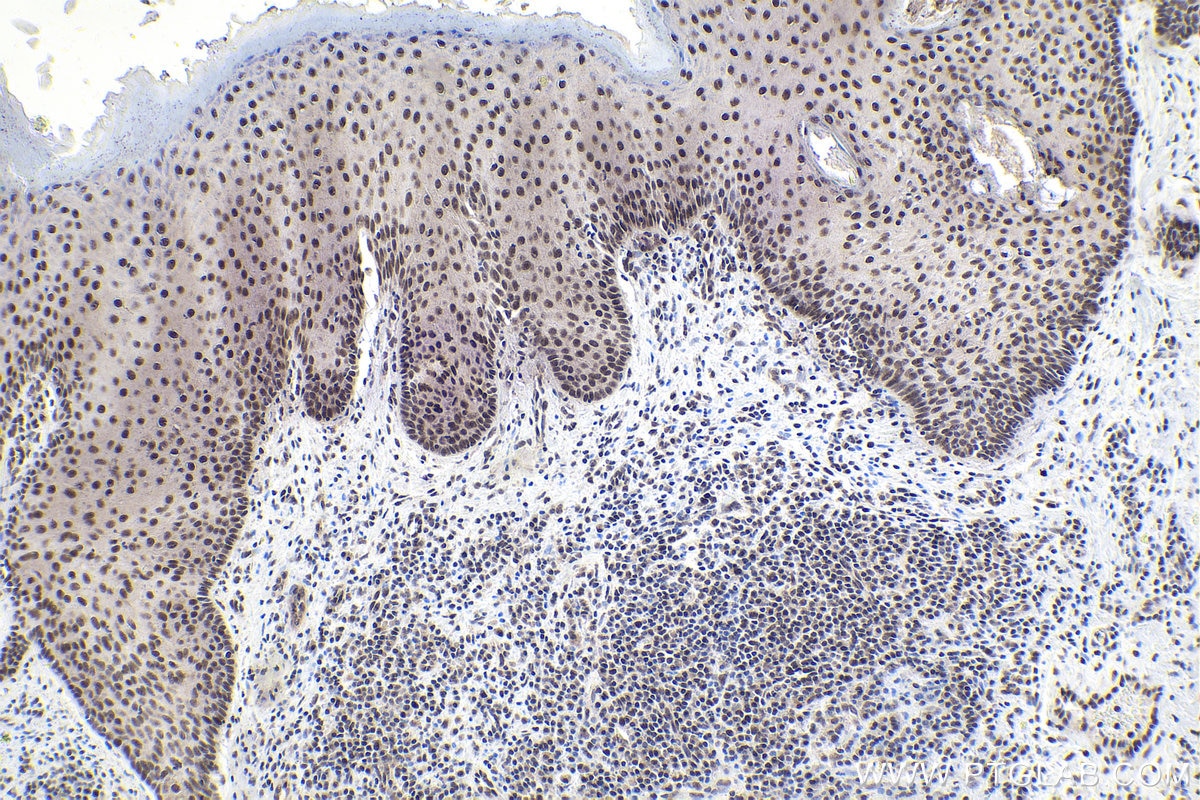 Immunohistochemical analysis of paraffin-embedded human skin cancer tissue slide using KHC1796 (SUPT6H IHC Kit).
