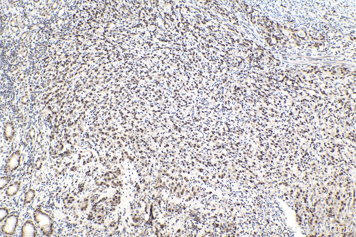 Immunohistochemical analysis of paraffin-embedded human stomach cancer tissue slide using KHC1796 (SUPT6H IHC Kit).