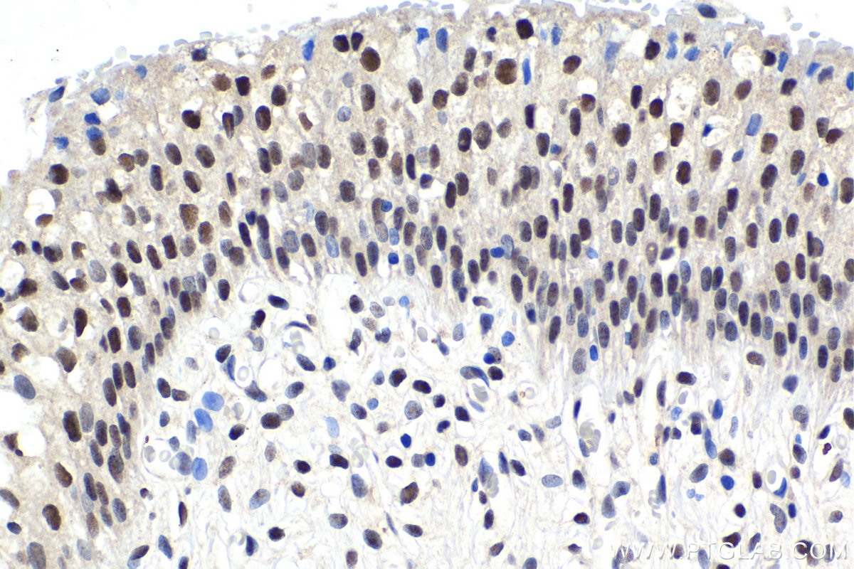 Immunohistochemical analysis of paraffin-embedded human urothelial carcinoma tissue slide using KHC1485 (SUPT7L IHC Kit).