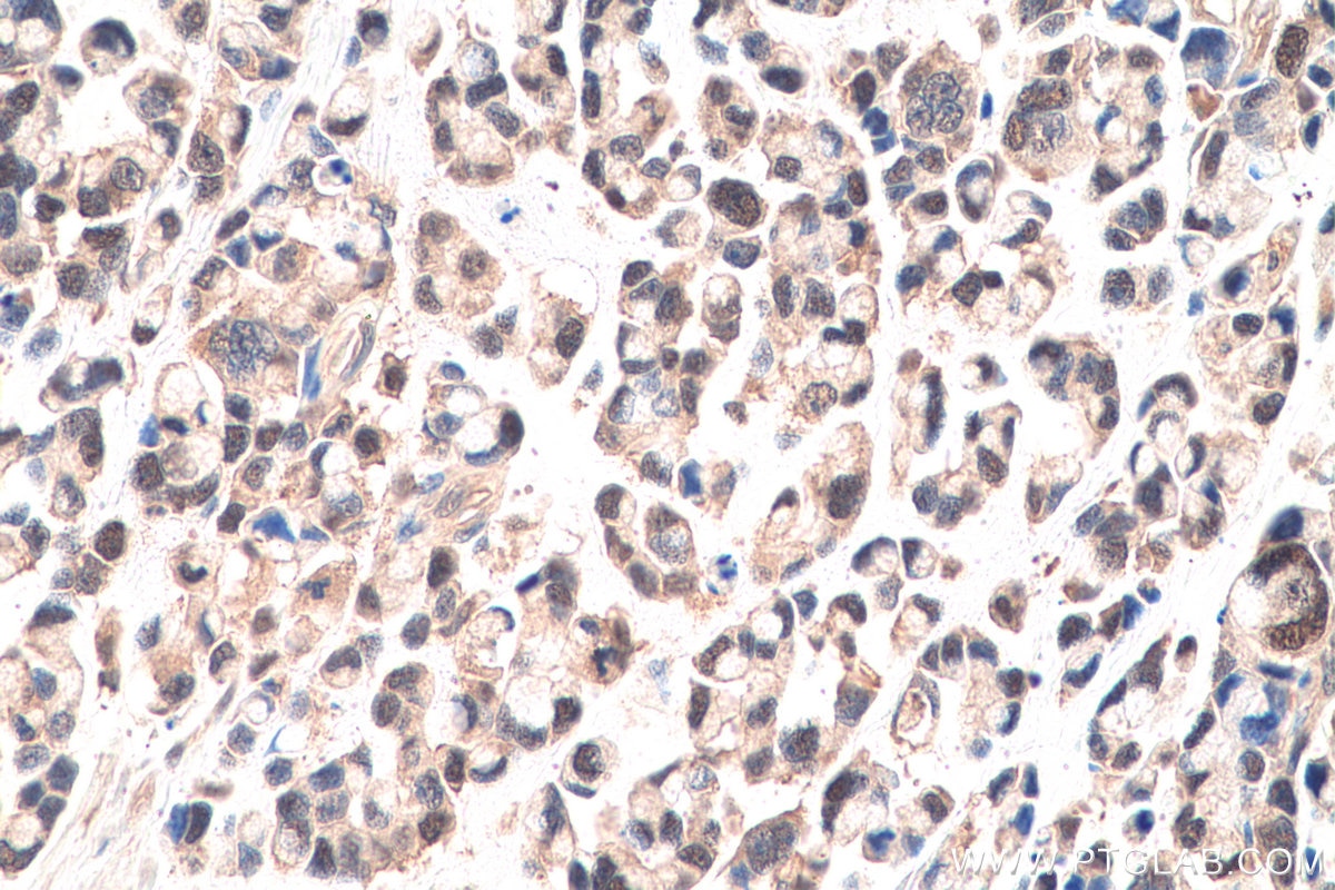 Immunohistochemical analysis of paraffin-embedded human colon cancer tissue slide using KHC0646 (SURVIVIN IHC Kit).