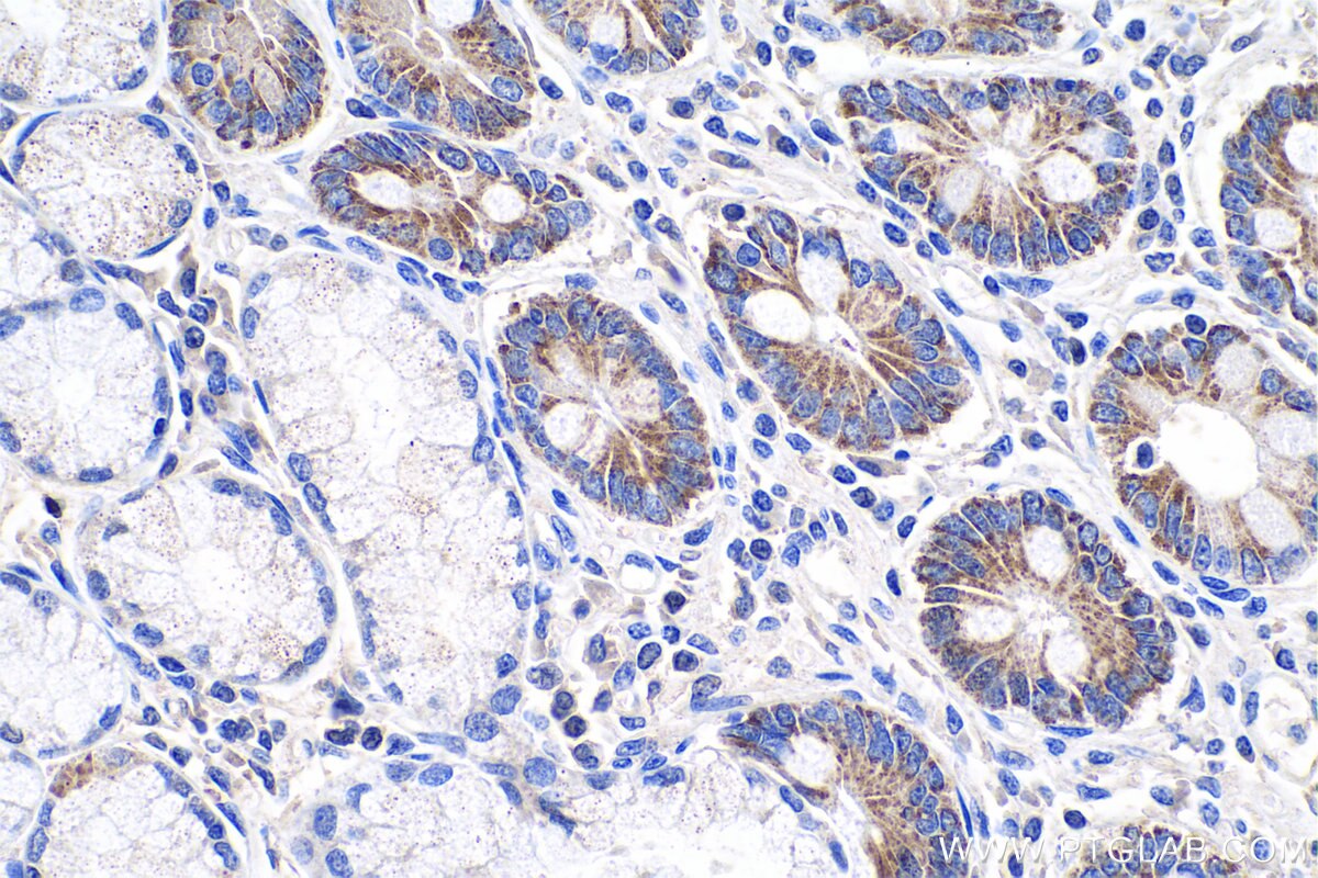 Immunohistochemical analysis of paraffin-embedded human stomach cancer tissue slide using KHC0646 (SURVIVIN IHC Kit).