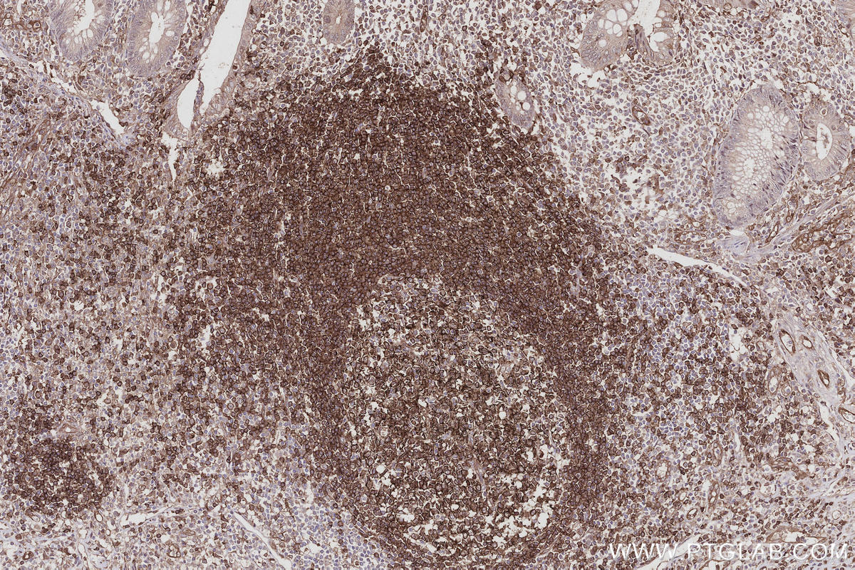 Immunohistochemical analysis of paraffin-embedded human appendicitis tissue slide using KHC3006 (SWAP70 IHC Kit).