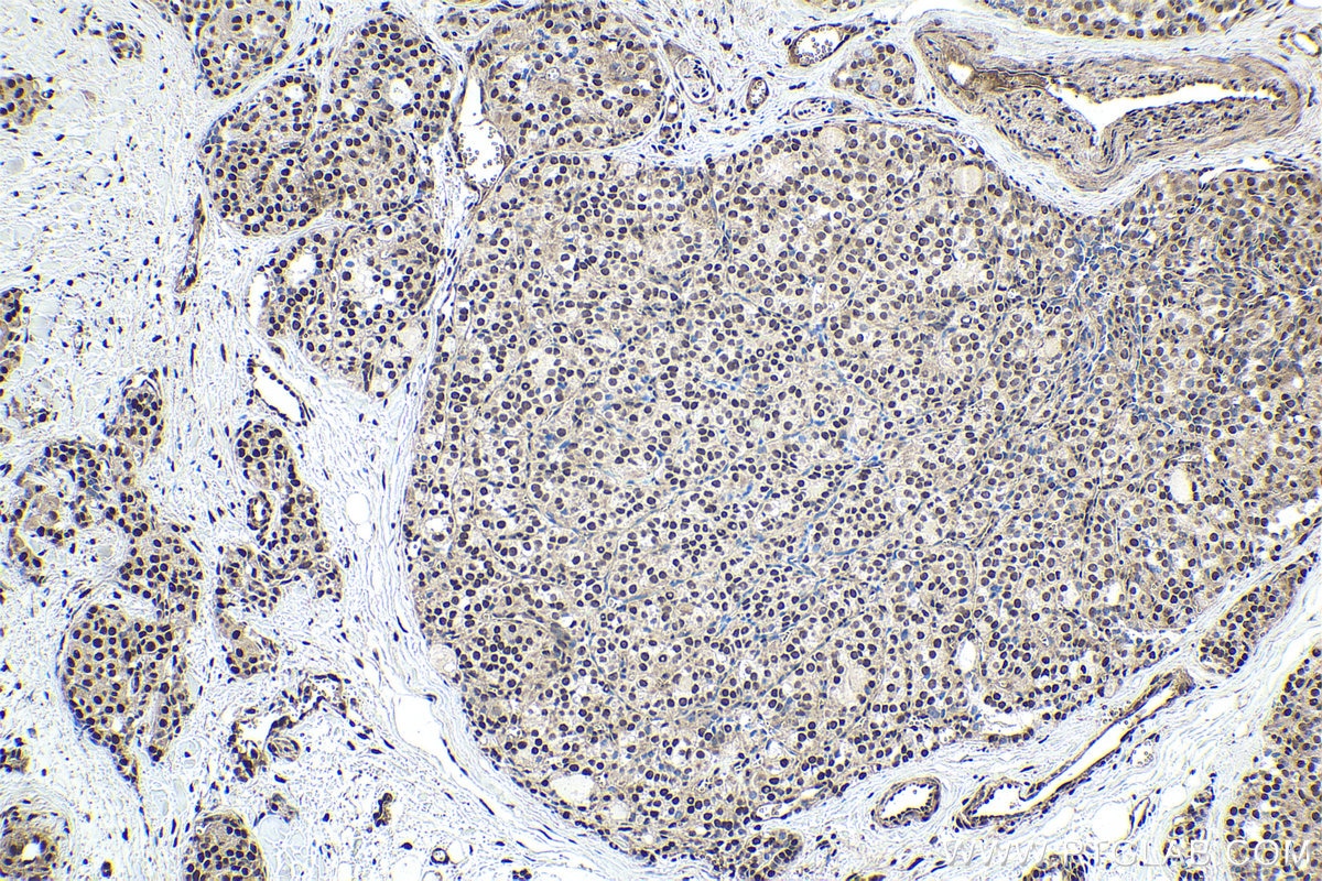Immunohistochemical analysis of paraffin-embedded human thyroid cancer tissue slide using KHC1857 (SYMPK IHC Kit).
