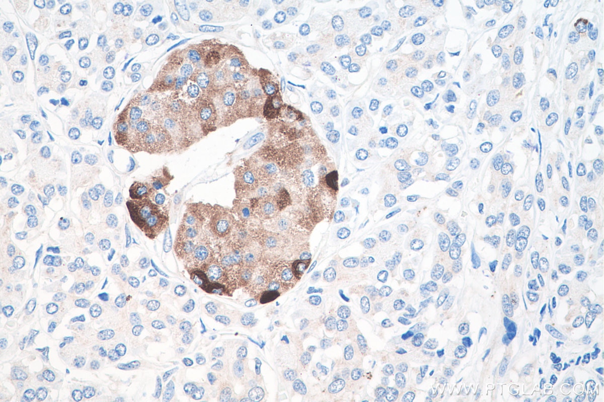 Immunohistochemical analysis of paraffin-embedded human pancreas cancer tissue slide using KHC0203 (Secretogranin II IHC Kit).