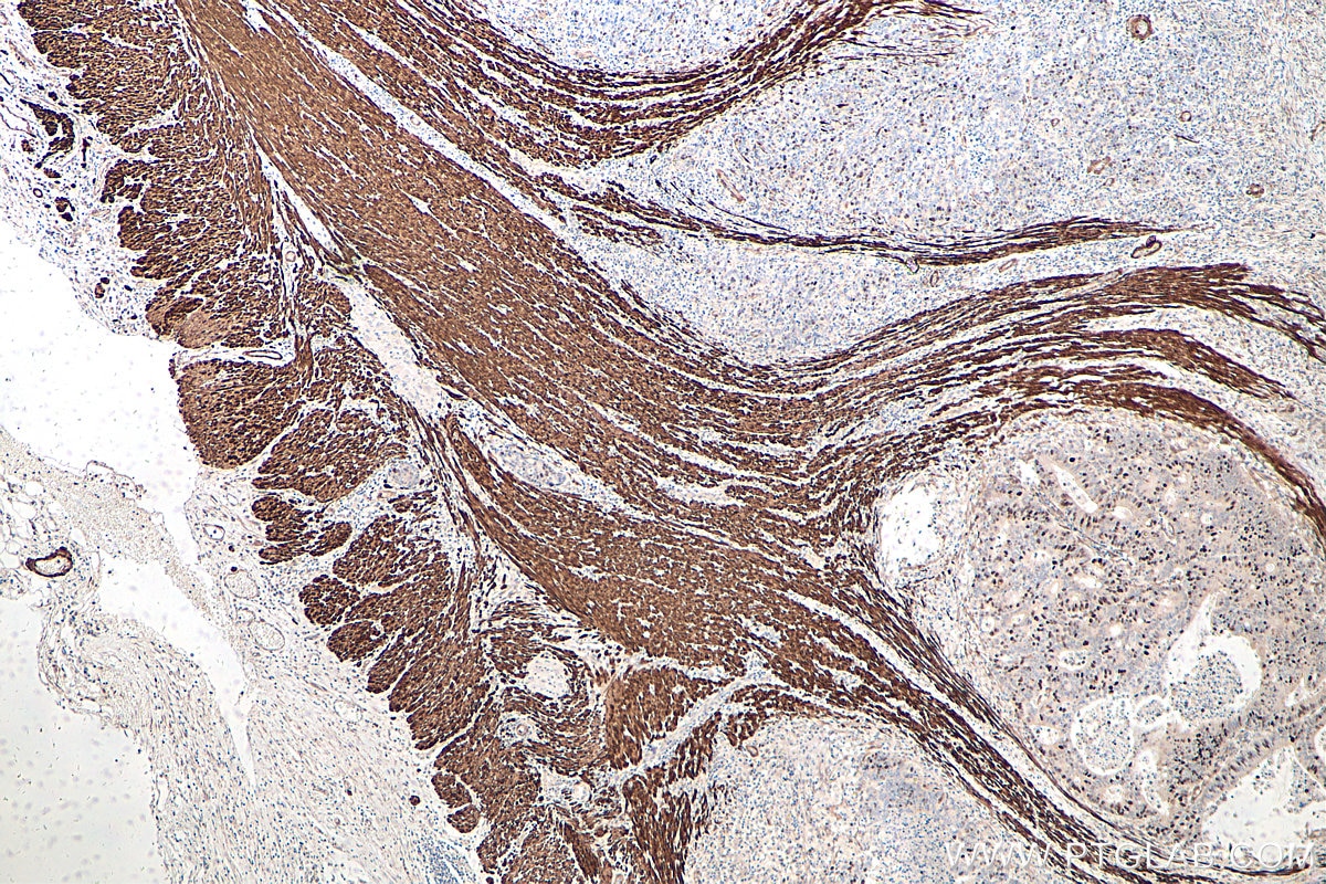 Immunohistochemical analysis of paraffin-embedded human colon cancer tissue slide using KHC0597 (Smoothelin/SMTN IHC Kit).