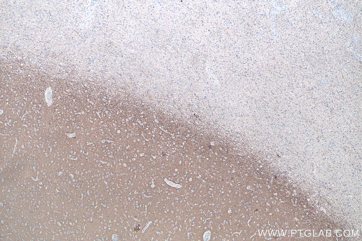 Immunohistochemical analysis of paraffin-embedded human gliomas tissue slide using KHC0059 (Synaptophysin IHC Kit).