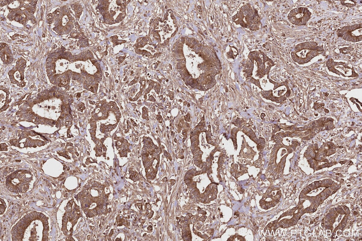 Immunohistochemical analysis of paraffin-embedded human rectal cancer tissue slide using KHC2801 (Syndetin/CCDC132 IHC Kit).