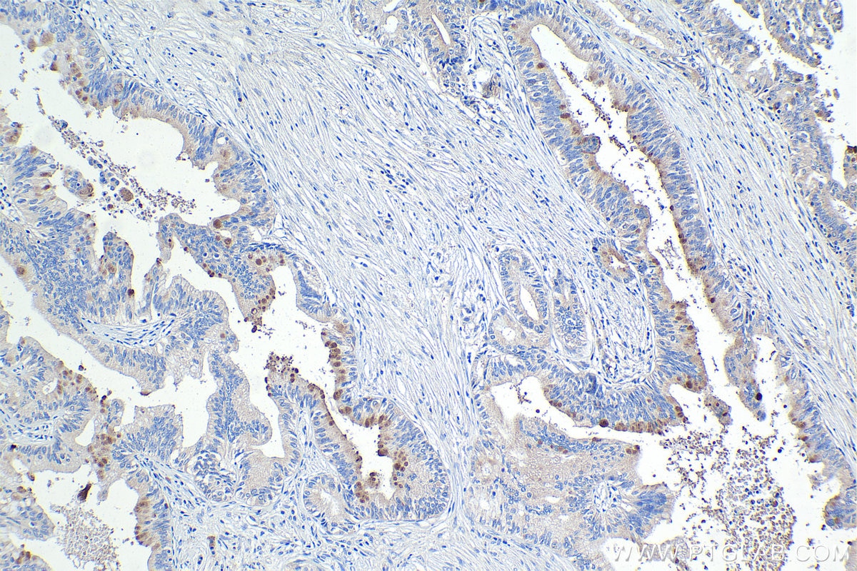 Immunohistochemical analysis of paraffin-embedded human pancreas cancer tissue slide using KHC1101 (TAC1 IHC Kit).