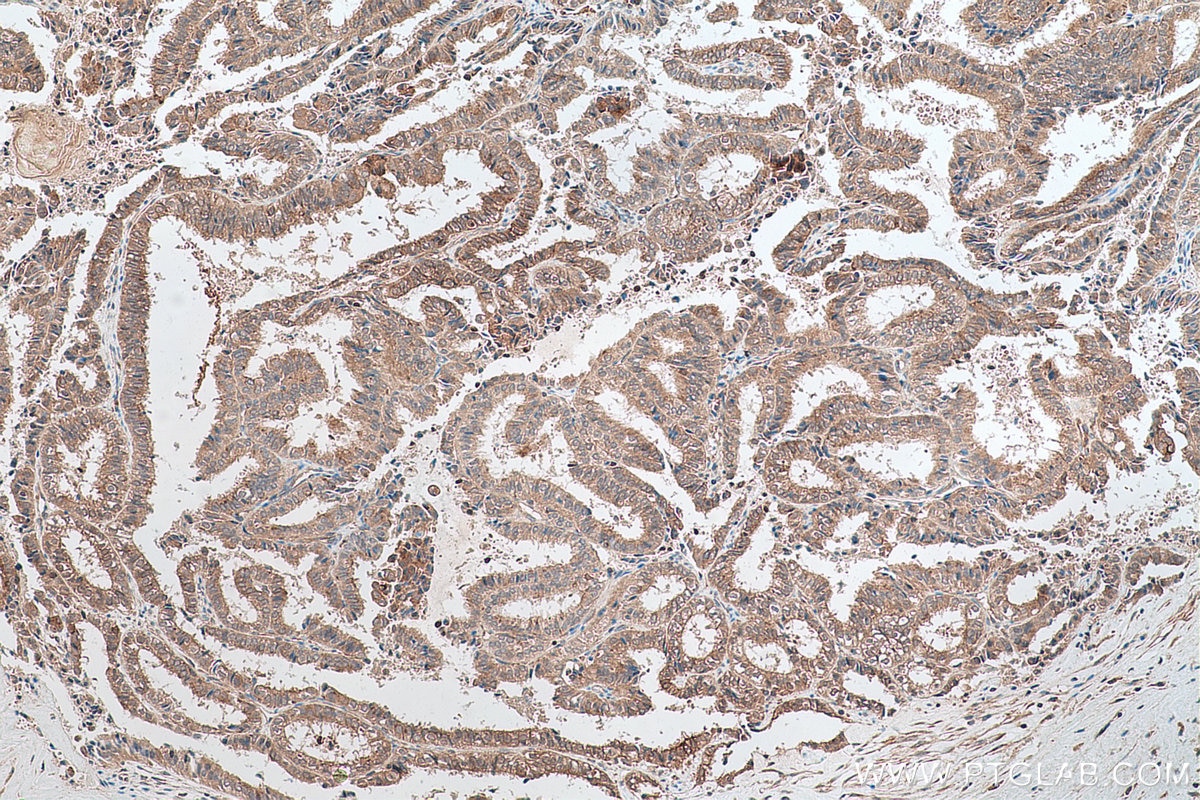 Immunohistochemical analysis of paraffin-embedded human ovary tumor tissue slide using KHC0647 (TACC1 IHC Kit).