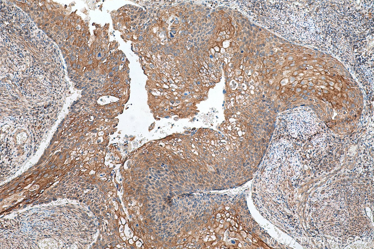 Immunohistochemical analysis of paraffin-embedded human cervical cancer tissue slide using KHC0647 (TACC1 IHC Kit).