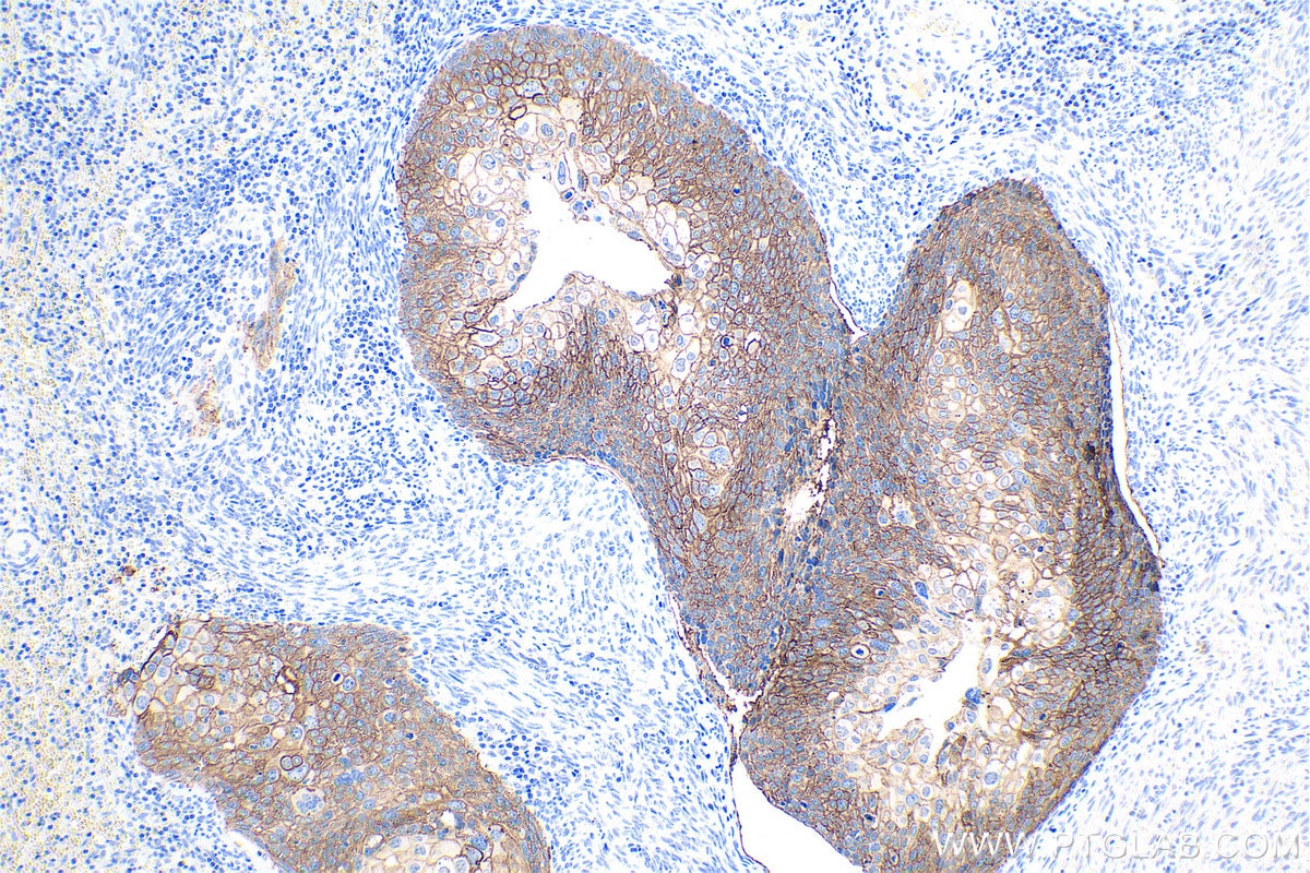 Immunohistochemical analysis of paraffin-embedded human cervical cancer tissue slide using KHC0821 (TACSTD2 IHC Kit).