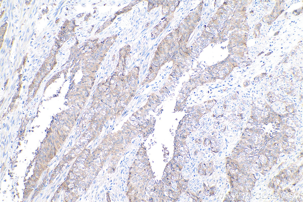 Immunohistochemical analysis of paraffin-embedded human urothelial carcinoma tissue slide using KHC0821 (TACSTD2 IHC Kit).