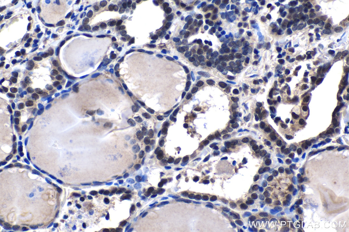 Immunohistochemical analysis of paraffin-embedded human thyroid cancer tissue slide using KHC1476 (TADA3L IHC Kit).