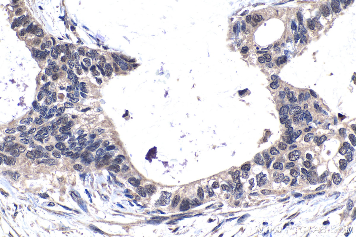 Immunohistochemical analysis of paraffin-embedded human urothelial carcinoma tissue slide using KHC1476 (TADA3L IHC Kit).