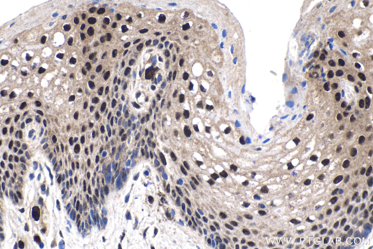 Immunohistochemical analysis of paraffin-embedded human cervical cancer tissue slide using KHC1858 (TAF15 IHC Kit).