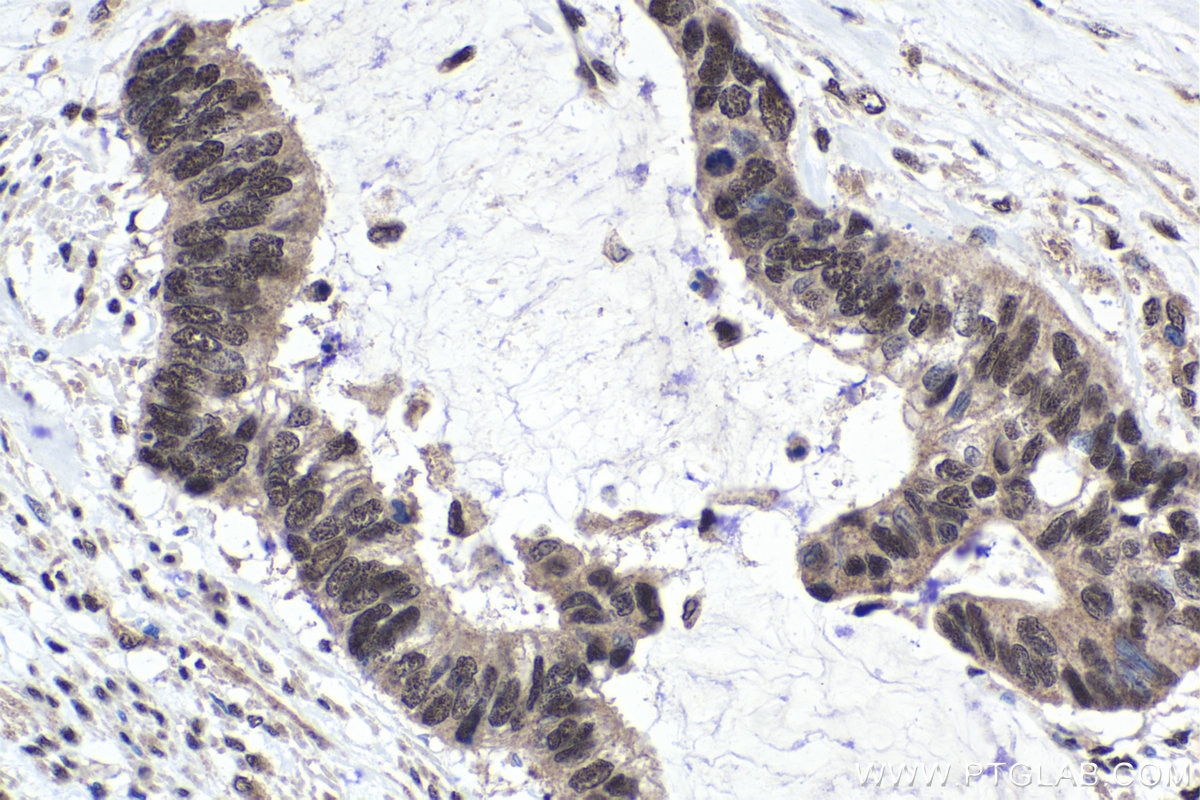 Immunohistochemical analysis of paraffin-embedded human urothelial carcinoma tissue slide using KHC1754 (TAF7 IHC Kit).