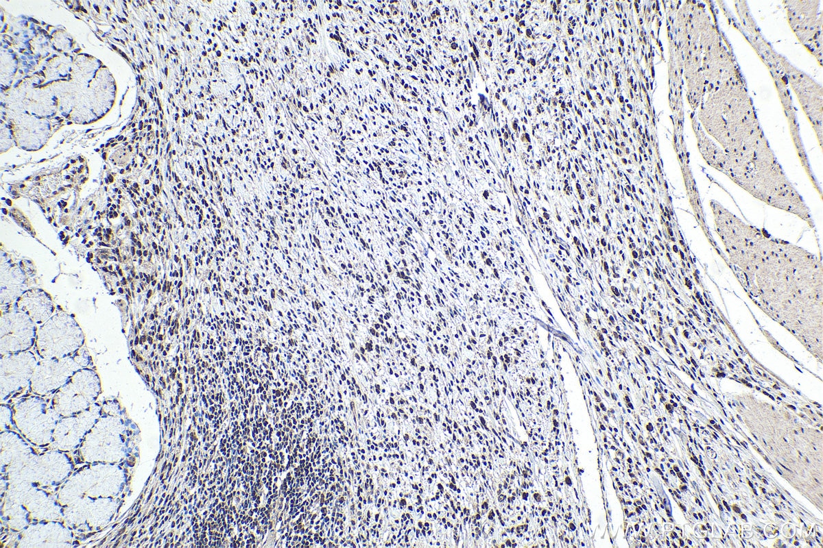 Immunohistochemical analysis of paraffin-embedded human stomach cancer tissue slide using KHC1754 (TAF7 IHC Kit).