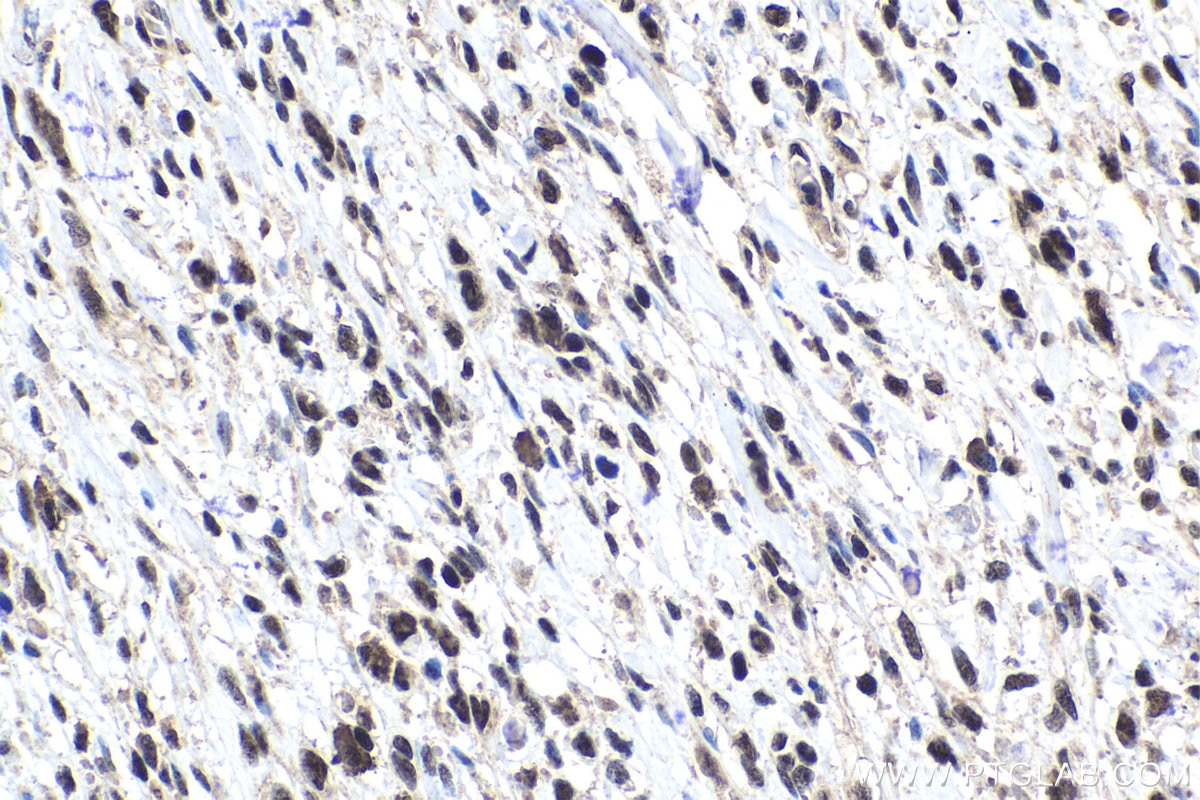 Immunohistochemical analysis of paraffin-embedded human stomach cancer tissue slide using KHC1754 (TAF7 IHC Kit).